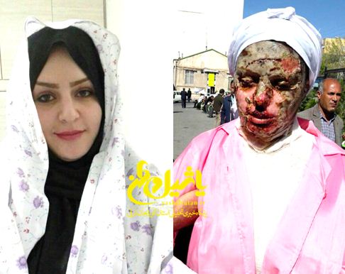 گفتگوی اختصاصی با زن ۲۶ ساله تبریزی که خواستگارش به صورتش اسید پاشید و دو انگشتش را با قمه قطع کرد