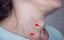 آنچه باید درباره پرکاری و کم کاری تیروئید بدانید