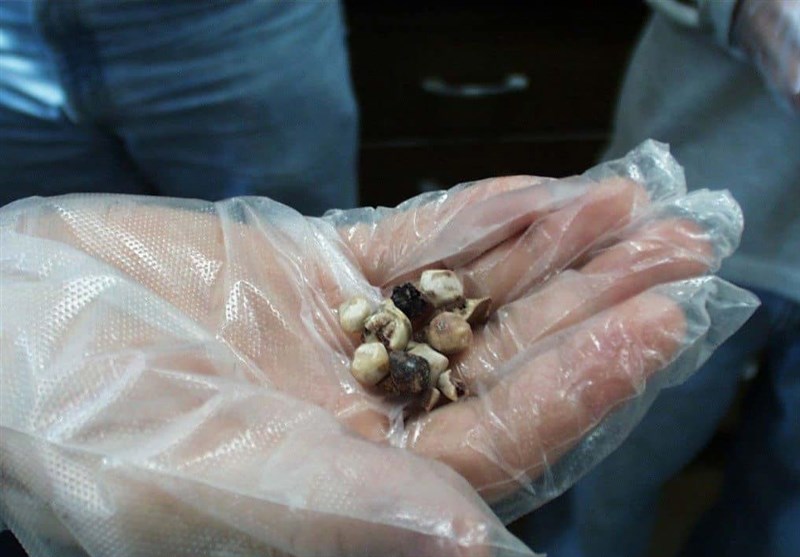 علائم سنگ کیسه صفرا چیست + راهکار درمانی طب سنتی